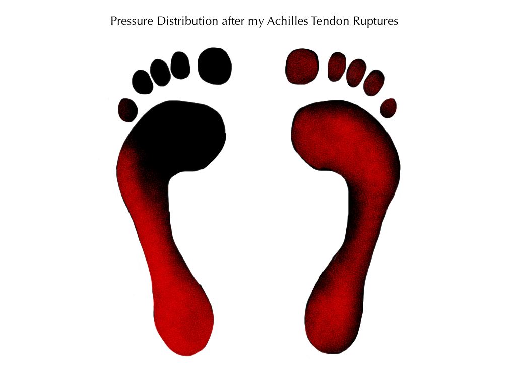 Mi distribución de la presión en los pies tras la rotura del tendón de Aquiles- Perspectiva del pie - Alineación - Pie