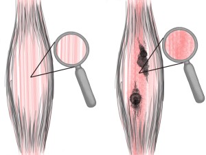 Soft Tissue Therapy - Knots and Adhesions Affect Striations in the Soft Tissue
