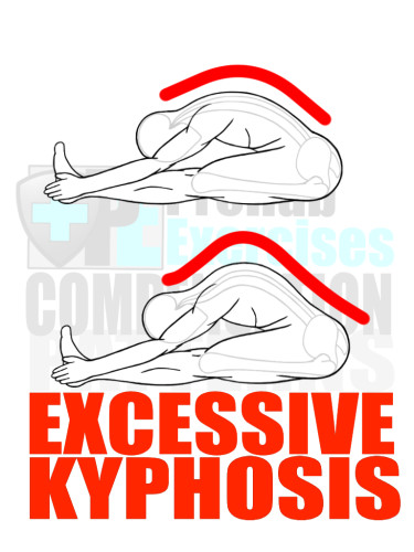 PreHab Exercise eBook - Alignment - Compensation Patterns - Excessive Kyphosis with Direction Lines