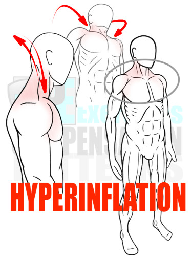 PreHab Exercise eBook - Alignment - Compensation Patterns - Hyperinflation with Direction Lines