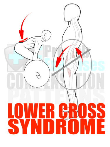 PreHab Exercise eBook - Alignment - Compensation Patterns -Lower Cross Syndrome with Direction Lines