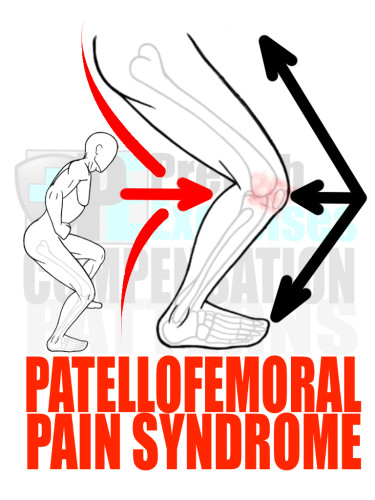 PreHab Exercise eBook - Alignment - Compensation Patterns - Patellofemoral Pain Syndrome - Sheer Froces - Close Up with Direction Lines