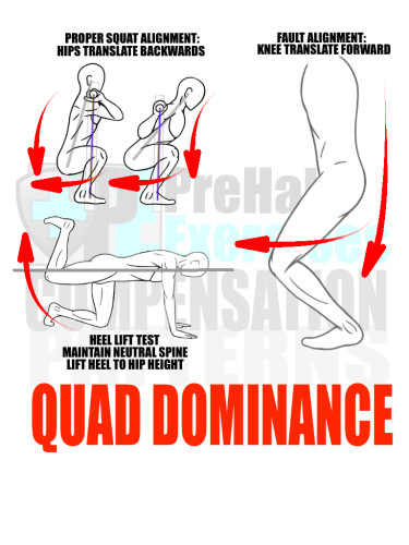 PreHab Exercise eBook - Alignment - Compensation Patterns - Quad Dominance with Direction Lines