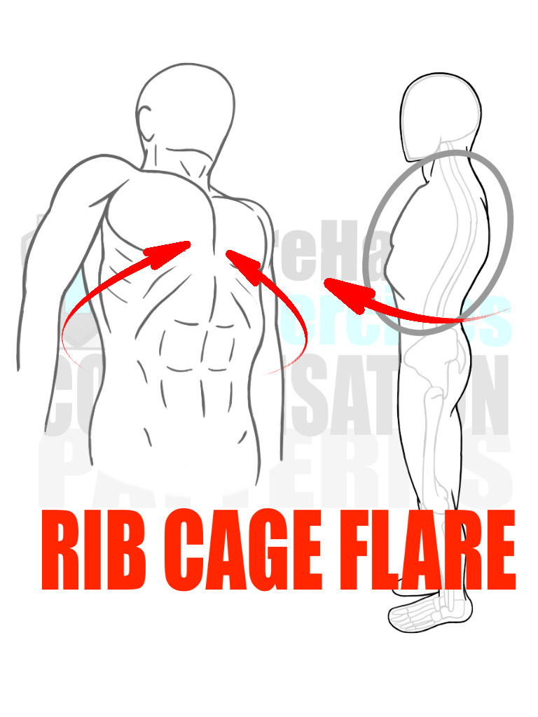 PreHab Exercise eBook Alignment Compensation Patterns Rib Cage Flare with Direction Lines