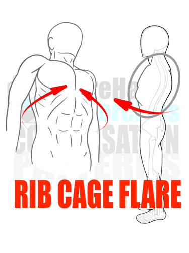PreHab Exercise eBook - Alignment - Compensation Patterns -Rib Cage Flare with Direction Lines