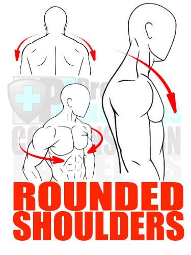 PreHab Exercise eBook - Alignment - Compensation Patterns - Rounded Shoulders with Direction Lines