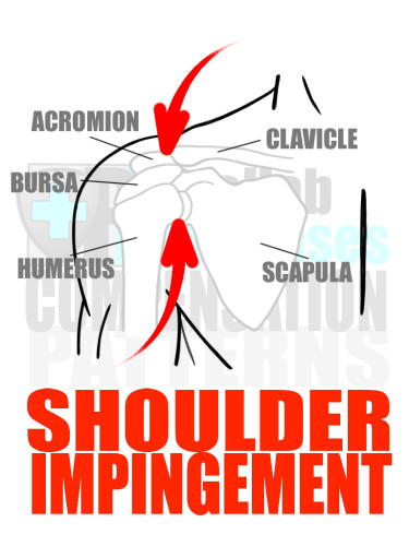 PreHab Exercise eBook - Alignment - Compensation Patterns - Shoulder Impingement with Direction Lines