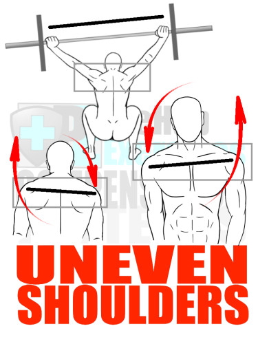 PreHab Exercise eBook - Alignment - Compensation Patterns - Uneven Shoulders with Direction Lines