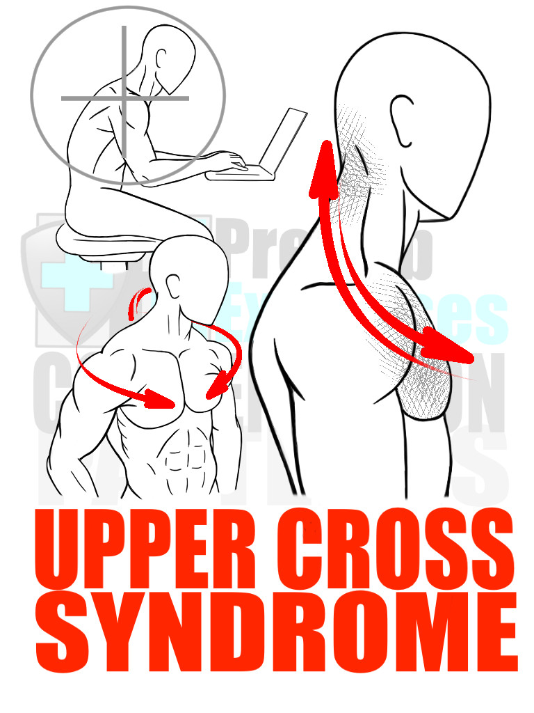 PreHab Exercise eBook - Alignment - Compensation Patterns -Upper Cross ...