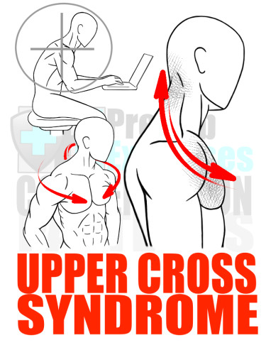 PreHab Exercise eBook - Alignment - Compensation Patterns -Upper Cross Syndrome with Direction Lines