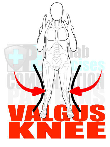 PreHab Exercise eBook - Alignment - Compensation Patterns - Valgus Knee with Direction Lines