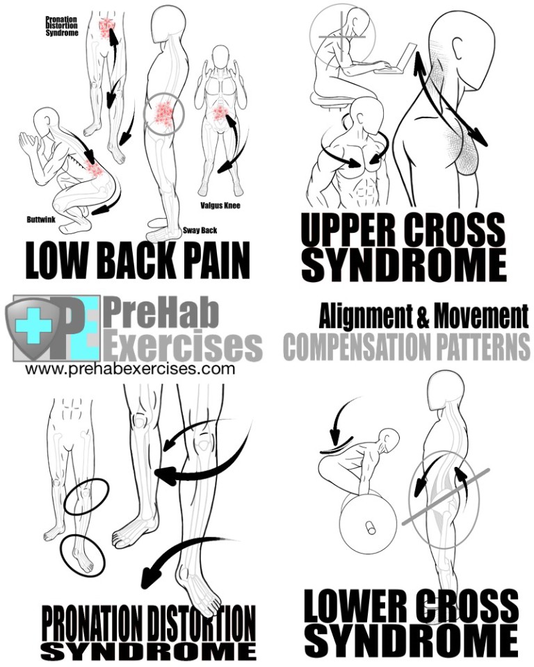 PreHab Exercises List of Common Compensation Patterns for Alignment and